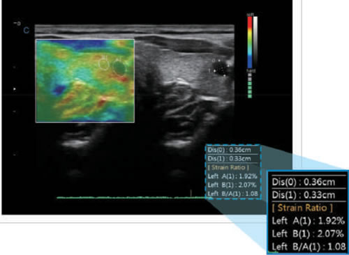 Chison Cbit 8Elastografia quantitativa